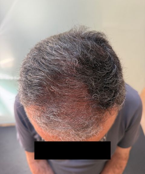 Couro cabeludo depois do tratamento