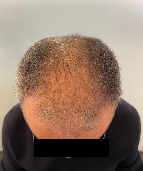Couro cabeludo durante o tratamento